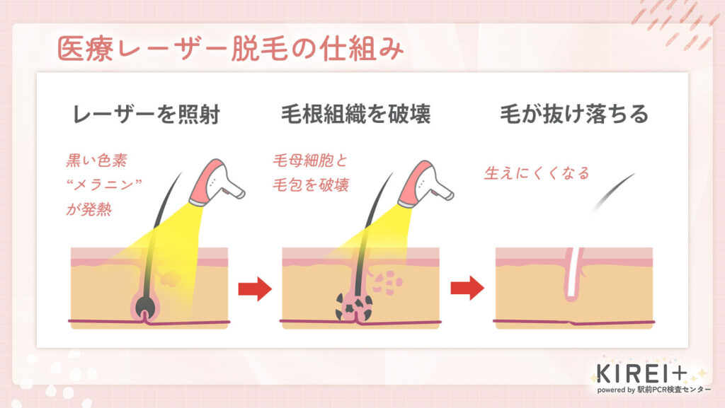 医療脱毛は機械選びが重要！医療レーザー脱毛の仕組みとは