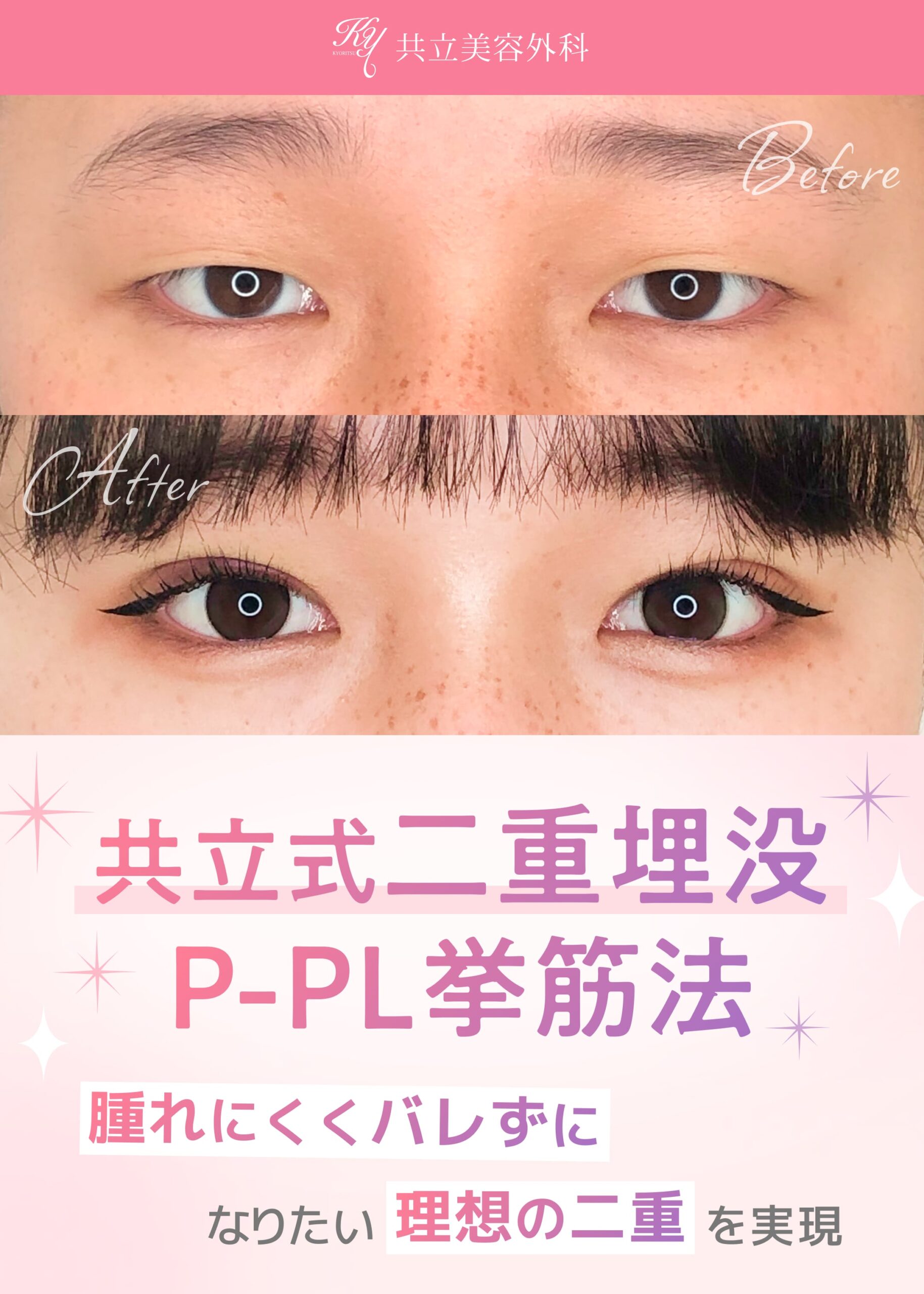 共立美容外科の共立式二重埋没PｰPL挙筋法